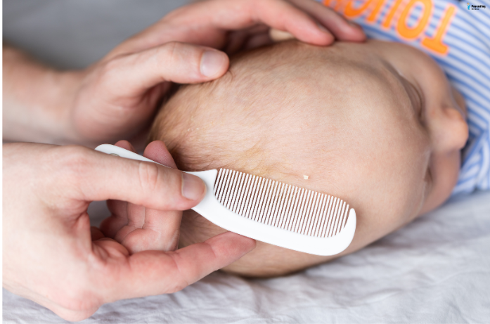 Parent gently brushing baby's scalp to care for cradle cap using a baby comb.