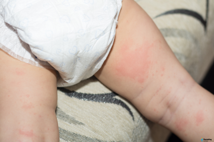 Close-up of baby skin with diaper rash showing irritation on the arm.