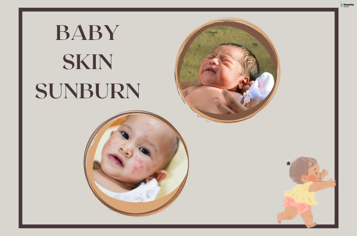 Baby with mild sunburn on cheeks, showing redness and tenderness, sign of baby skin sunburn.
