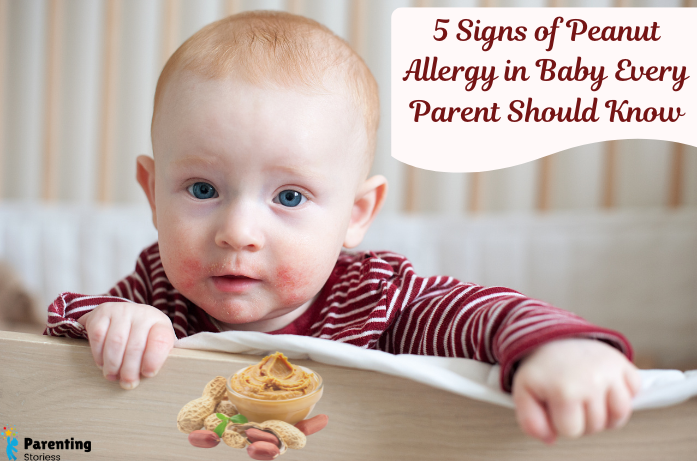 5 Signs of Peanut Allergy in baby